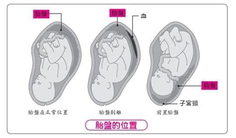 五官 五行 胎盤剝離方式